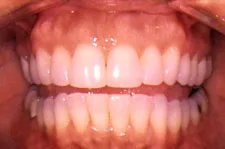 ClearCorrect after