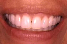 ClearCorrect after