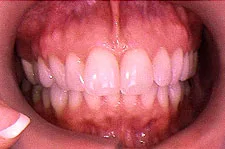 ClearCorrect before