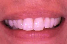 ClearCorrect before