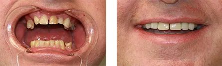 Before and after dental crowns