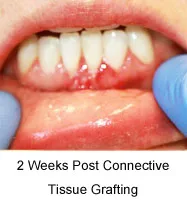 Gum graft two weeks after