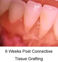 Gum graft six weeks after