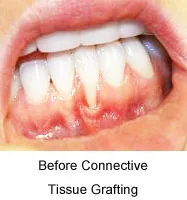 Gum graft before
