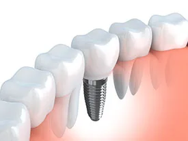 Dental implant illustration