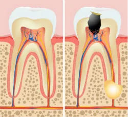 Root canal therapy